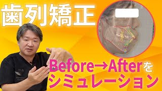 【矯正のBefore→After】シミュレーションで仕上がりを予測！