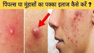 पिंपल्स या मुंहासों का पक्का इलाज कैसे करें ? कील, मुहांसे और पिंपल्स को कैसे रोकें ? Cure pimples