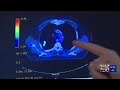 Lung cancer awareness: Get screened to stay safe