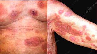 What is Mycosis Fungoides? Symptoms, Causes, Treatment, Diagnosis: Cutaneous T Cell Lymphoma