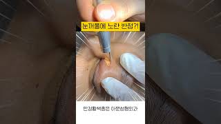 안검황색종, 눈꺼풀 노란색 반점, 치료 레이져 시술 (고지혈증 콜레스테롤 병원 xanthelasma laser SEOUL KOREA)[아문TV]