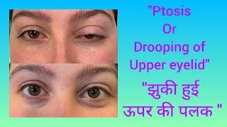 झुकी पलक/ Drooping of upper eyelid/ Ptosis