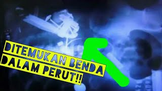 DITEMUKANNYA BANYAK PAKU DIDALAM PERUT PRIA INI..