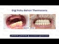 Proses Pemasangan Gigi Palsu Bahan Thermosens Rahang Atas & Bawah (Full Denture) di Permata Dental