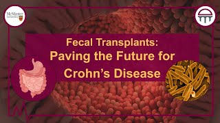 Fecal Transplants: Paving the Future for Crohn’s Disease