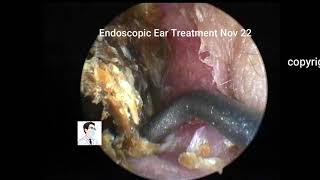 Ear wax removal with dr zhao video  20211122