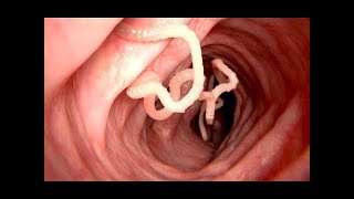 10 Scary Parasites YOU May Have!