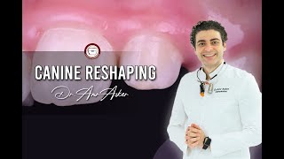 canine reshaping to be lateral (canine substitution) by Dr Amr Asker in missing lateral