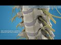 cervical herniated disc