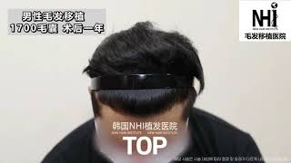 男性发际线毛发种植 1700毛囊 术后1年