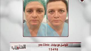 الطبيب | خيوط الابتوس لشد الوجه مع Yes Clinic