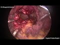 Sigmoido - Vaginal Fistula - Laparoscopic Repair ( Goa - 2024)