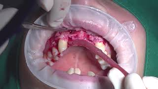 Early dental implant placement in the anterior zone