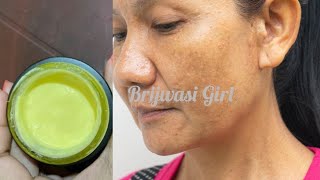 झाइयों के लिए सबसे अच्छा क्रीम ! best cream for melasma