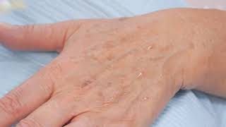 Jalupro hand treatment