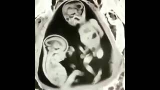 Twin's Fighting In Mom's Womb | Real .