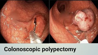 COLONIC POLYPECTOMY l ক্লোলনিক পলিপেকটমি #BD_ENDOSCOPY