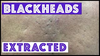 Were these blackheads \u0026 cysts from Agent Orange exposure?