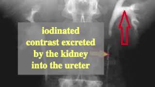 iodinated contrast used for intravenous pyelography (IVP)