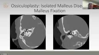 Bone Anchored Hearing Devices by Matthew O'Malley, MD