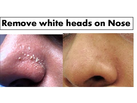 Turmeric to remove White heads on Nose| Starnaturalbeauties Turmeric to remove White heads on Nose| Starnaturalbeauties