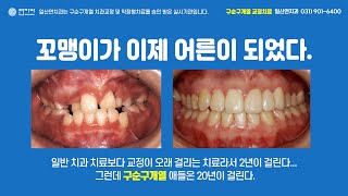 일산연치과, 내 인생이 의미가 있는 것일거라 생각하며 했던 구순구개열교정치료가 벌써 30년되었다.