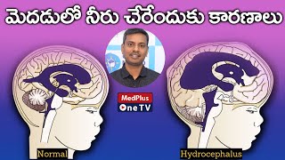 Hydrocephalus Causes and Symptoms | Dr.Aneel Kumar @MedPlusONETV