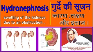 Obstruction in Kidney, गुर्दे के रास्ते में रुकावट | Hydronephrosis.  Dr.(Prof)Santosh Kumar PGI.