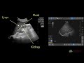 Point of Care Ultrasound for Ascites (POCUS)