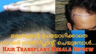 എന്റെ ഹെയർ  ട്രാൻസ്‌പ്ലാന്റ് 8 മാസം പിന്നിടുമ്പോൾ | My Hair Transplant @ Kerala without Medicine