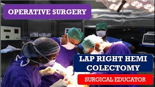 LAP RIGHT HEMICOLECTOMY/ STEP BY STEP/ OPERATIVE SURGERY