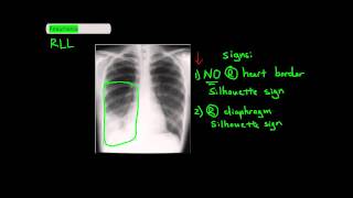 Identifying which Lung Lobe a Puemonia is in [UndergroundMed]