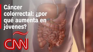 A qué se debe el aumento de casos de cáncer colorrectal y cómo ayudar a prevenirla