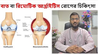 বাত বা রিমোটিক আর্থ্রাইটিস রোগের  চিকিৎসা | Treatment of arthritis or rheumatoid arthritis