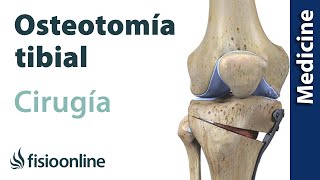 OSTEOTOMÍA TIBIAL: Técnica de la artrosis de rodilla sin prótesis