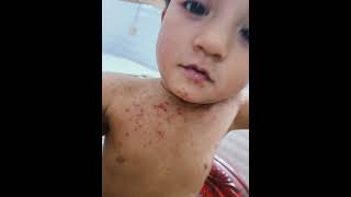 #চর্মরোগ #বাচ্চাদের চর্মরোগ #impetigo #impetigo contagious #atopic dermatitis #allergy #skin disease