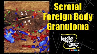 Scrotal Foreign Body Granuloma || Ultrasound || Case 254