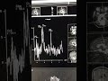 Pilocytic astrocytoma with drop metastasis