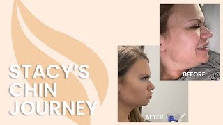 Sono Bello | Laser Liposuction | Ditch your chin fat in 1 day!