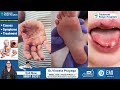 చిన్న పిల్లల్లో వచ్చే ఇన్ఫెక్షన్స్ signs and symptoms of hand foot and mouth disease trh