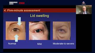 Thyroid Update Series    Thyroid Eye Disease   4 March 2023