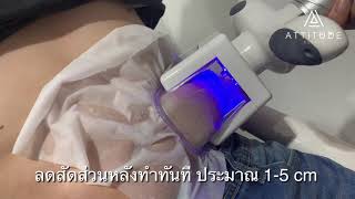 Fat Freezing สลายไขมันด้วยความเย็นเยือกแข็ง -14 องศา