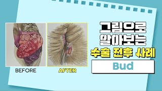 치질 수술 사례 ep 8 : bud | 항문질환 수술은 대장항문외과에서! | 서울GS항외과