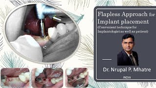 Flapless Approach for Implant placement (Convenient technique for Implantologist as well as patient)