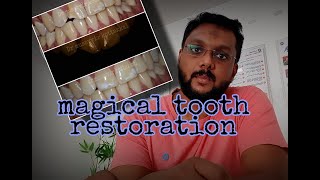 Magical tooth restoration. പല്ല് പൊട്ടിയാൽ എന്ത് ചെയ്യുo?