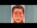 Orbital complications  secondary to sinusitis Part I  (Hindi) Patient teaching  programme