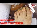 Nails|nails Tutorial|nails Transformation|Θεραπεία Ονύχων|Ποδιατρική|Κέντρο Ποδιού Podiatry|Νύχια