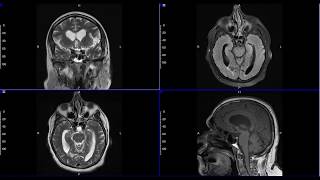 Brain MRI of Parkinsonian signs and symptoms \u0026 possible Normal Pressure Hydrocephalus (NPH).