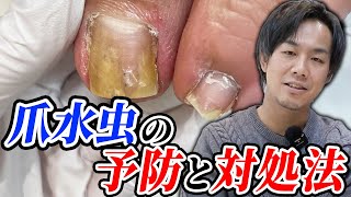 水虫予防は毎日○○をするだけ！対処法についても詳しく解説！！【感染症】