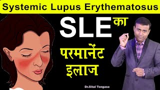 systemic lupus erythematosus (SLE) का परमनेंट इलाज I systemic lupus erythematosus treatmen